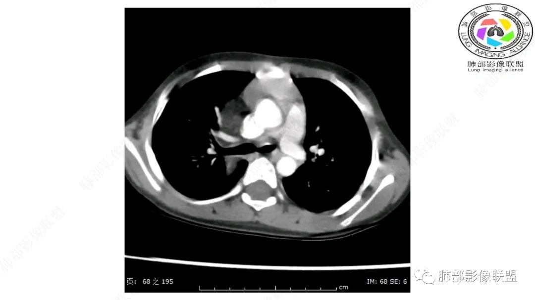 【病例】幼儿脂肪母细胞瘤1例CT影像-27