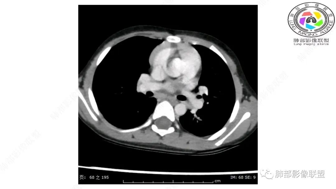 【病例】幼儿脂肪母细胞瘤1例CT影像-28