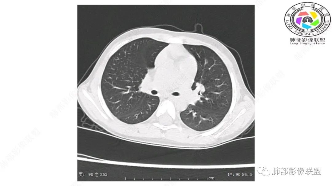 【病例】幼儿脂肪母细胞瘤1例CT影像-29