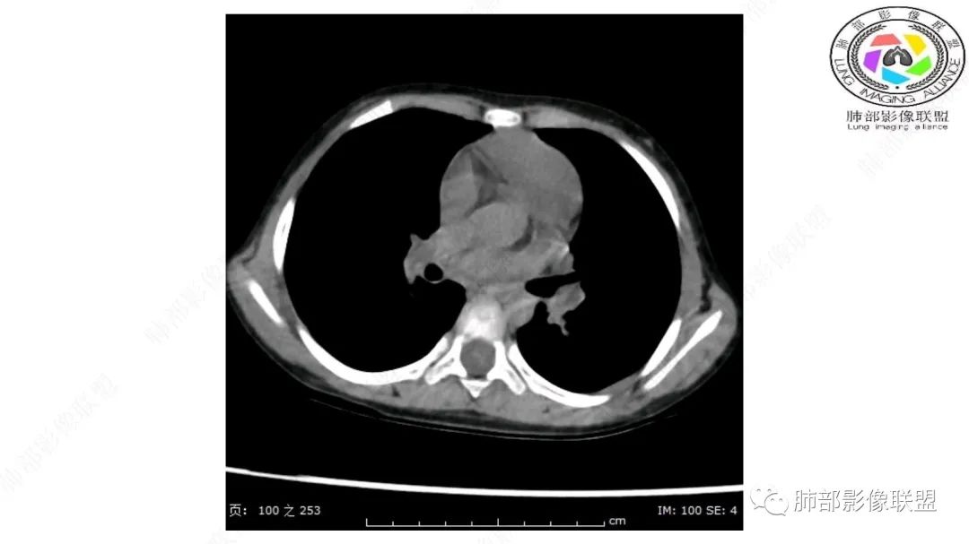 【病例】幼儿脂肪母细胞瘤1例CT影像-30