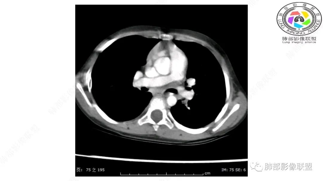【病例】幼儿脂肪母细胞瘤1例CT影像-31