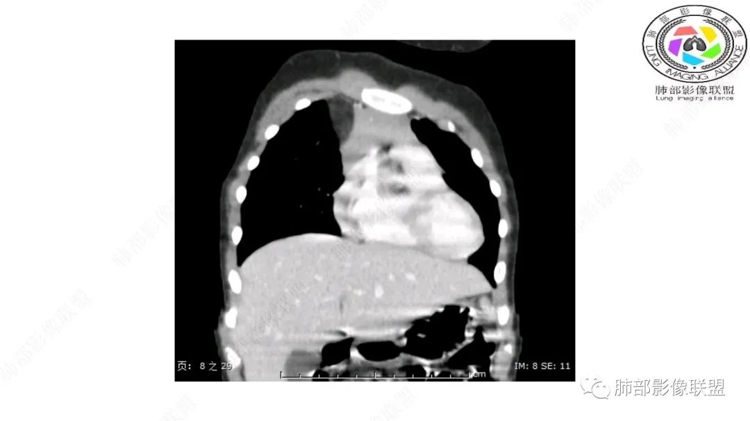 【病例】幼儿脂肪母细胞瘤1例CT影像-34