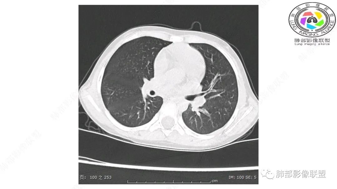 【病例】幼儿脂肪母细胞瘤1例CT影像-33