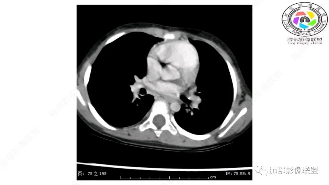 【病例】幼儿脂肪母细胞瘤1例CT影像-32