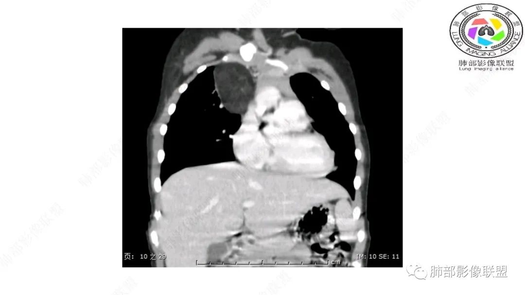 【病例】幼儿脂肪母细胞瘤1例CT影像-35