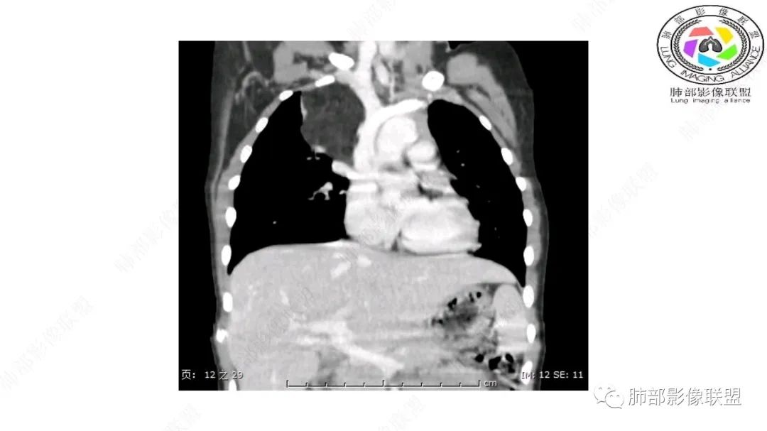 【病例】幼儿脂肪母细胞瘤1例CT影像-36
