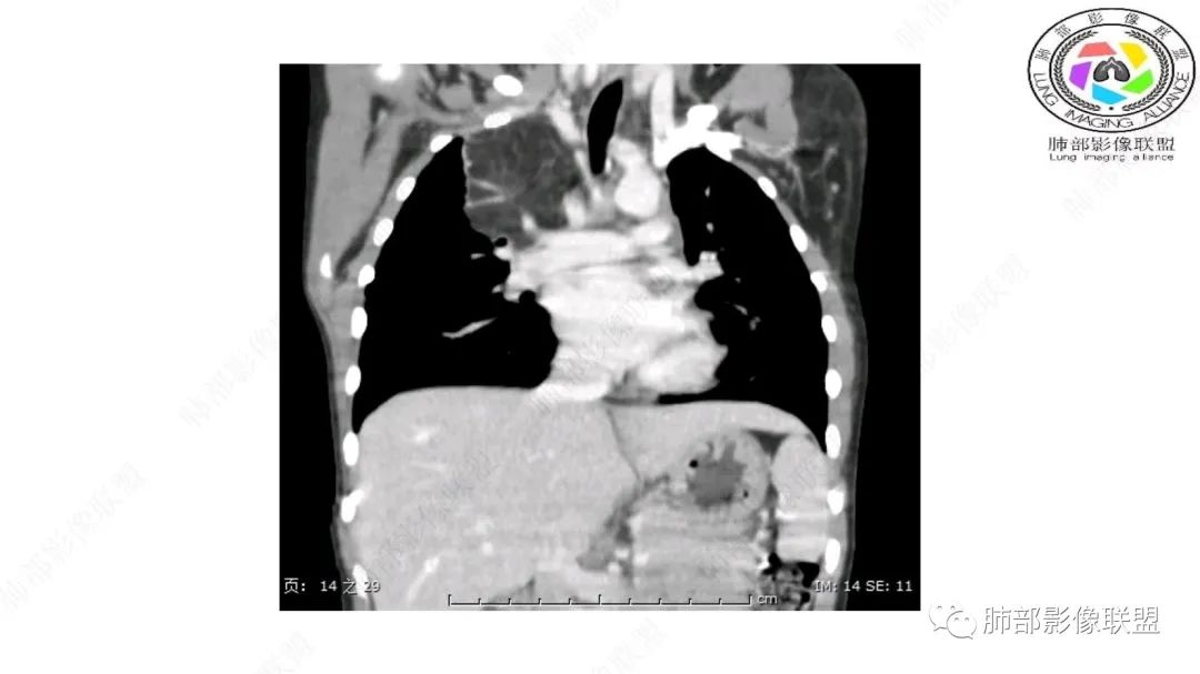 【病例】幼儿脂肪母细胞瘤1例CT影像-37