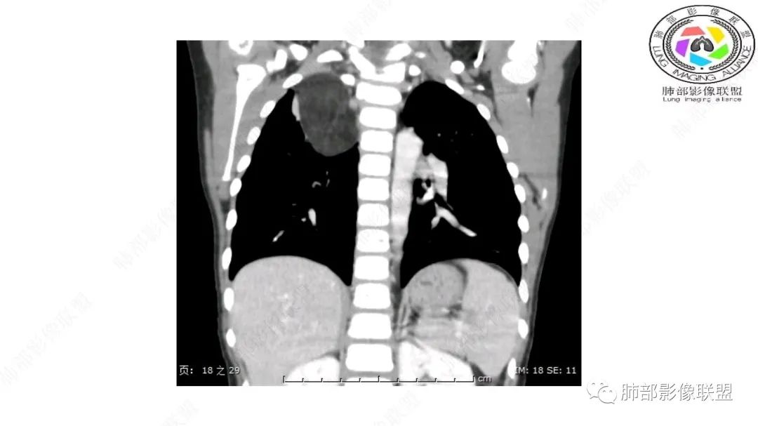 【病例】幼儿脂肪母细胞瘤1例CT影像-39