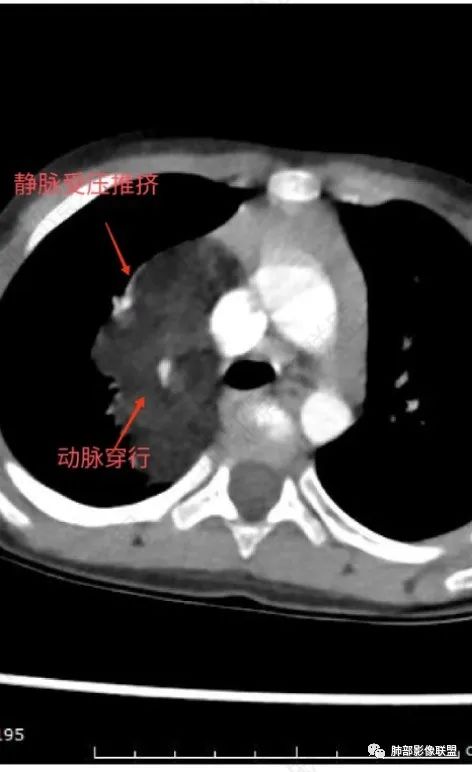 【病例】幼儿脂肪母细胞瘤1例CT影像-45