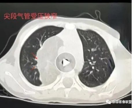 【病例】幼儿脂肪母细胞瘤1例CT影像-46