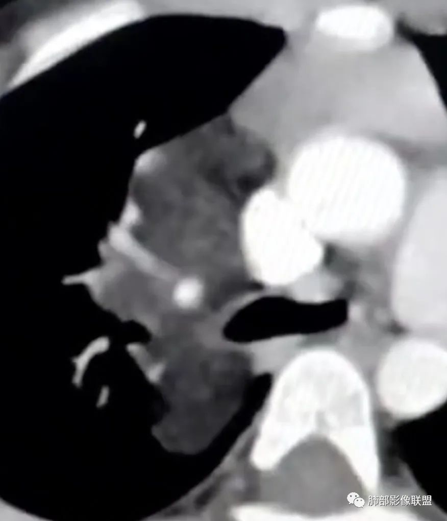 【病例】幼儿脂肪母细胞瘤1例CT影像-47