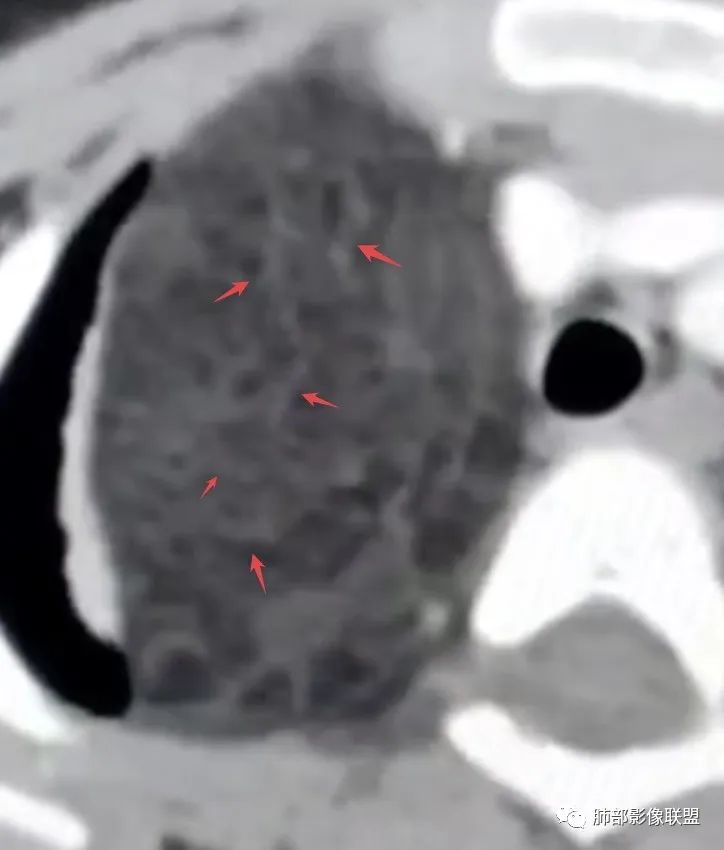 【病例】幼儿脂肪母细胞瘤1例CT影像-48