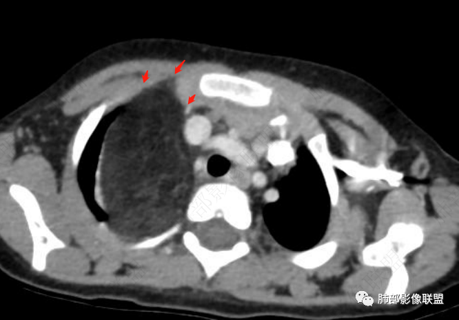 【病例】幼儿脂肪母细胞瘤1例CT影像-50
