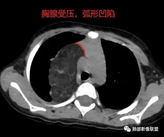 【病例】幼儿脂肪母细胞瘤1例CT影像-51
