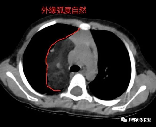 【病例】幼儿脂肪母细胞瘤1例CT影像-52