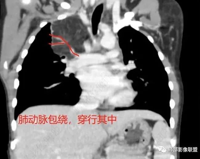 【病例】幼儿脂肪母细胞瘤1例CT影像-53