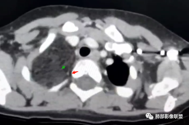 【病例】幼儿脂肪母细胞瘤1例CT影像-54
