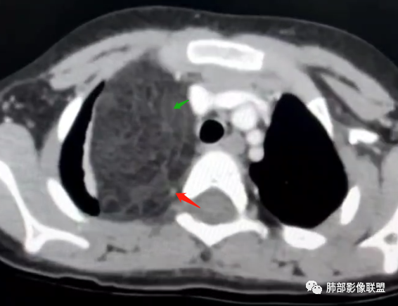 【病例】幼儿脂肪母细胞瘤1例CT影像-55