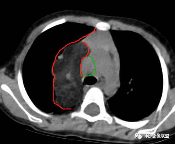 【病例】幼儿脂肪母细胞瘤1例CT影像-56