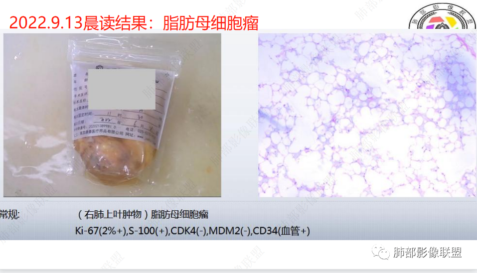 【病例】幼儿脂肪母细胞瘤1例CT影像-58