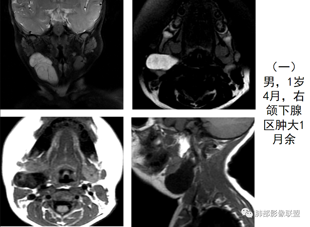 【病例】幼儿脂肪母细胞瘤1例CT影像-59