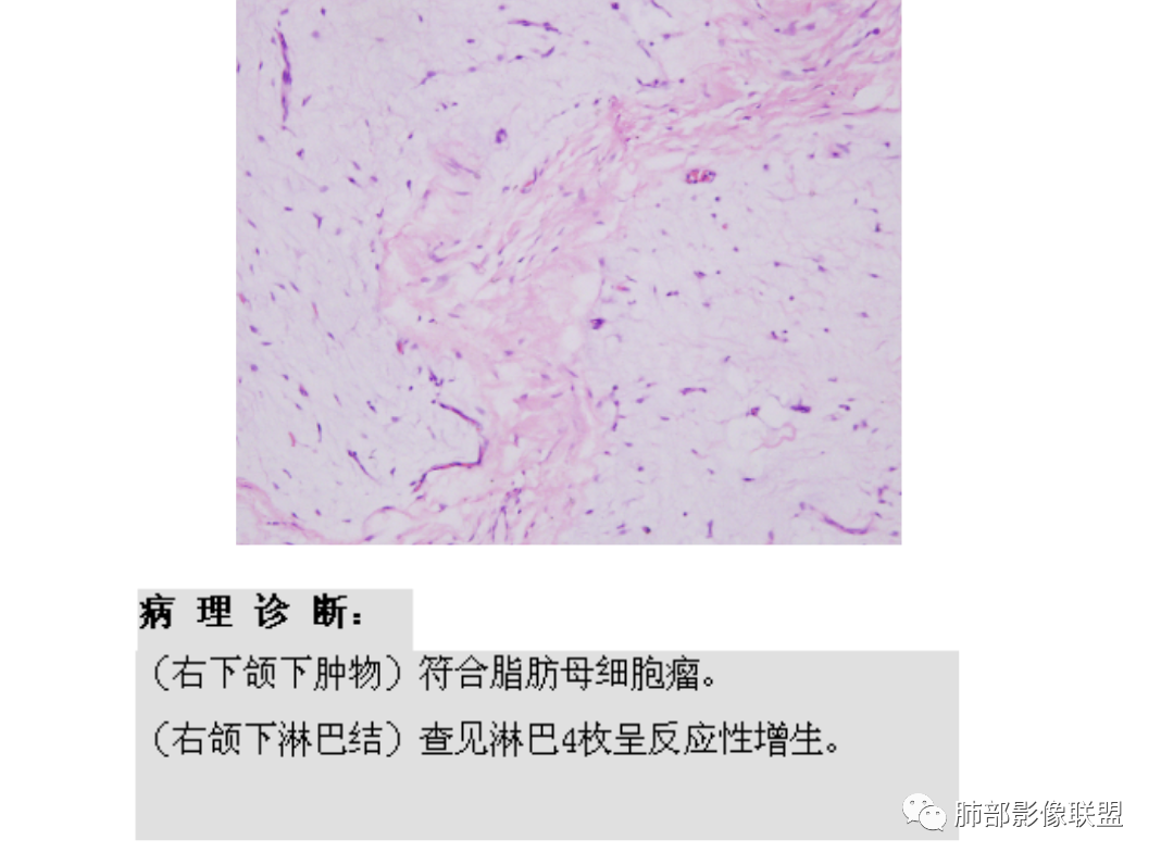 【病例】幼儿脂肪母细胞瘤1例CT影像-60