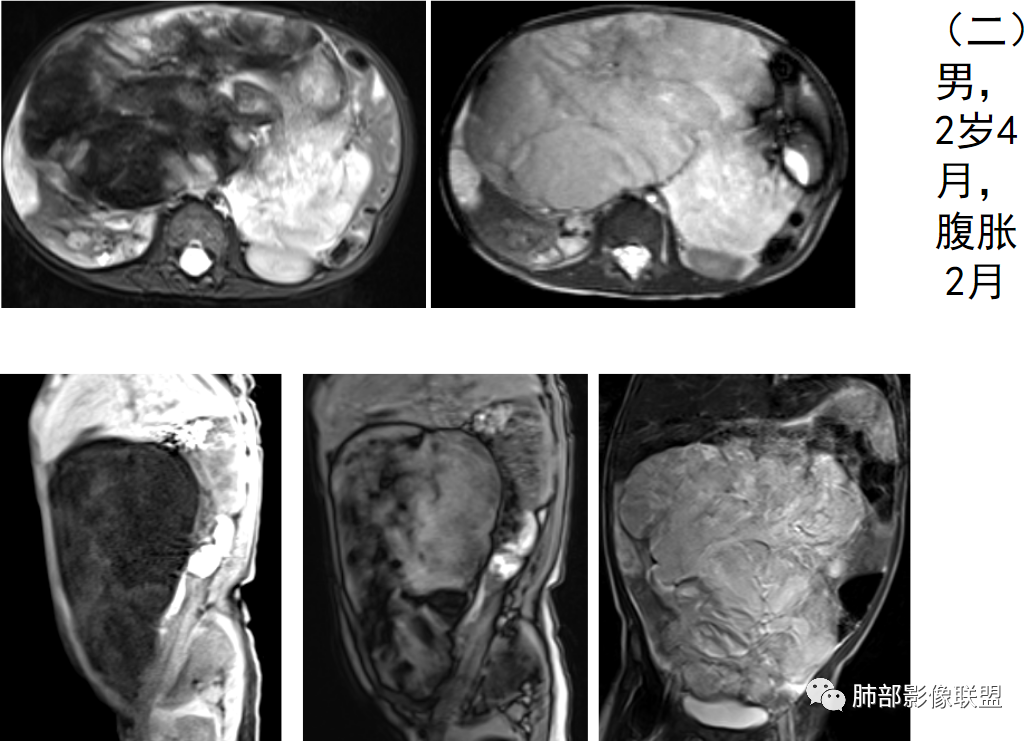 【病例】幼儿脂肪母细胞瘤1例CT影像-61