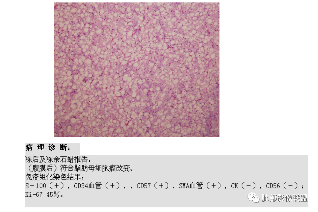 【病例】幼儿脂肪母细胞瘤1例CT影像-62
