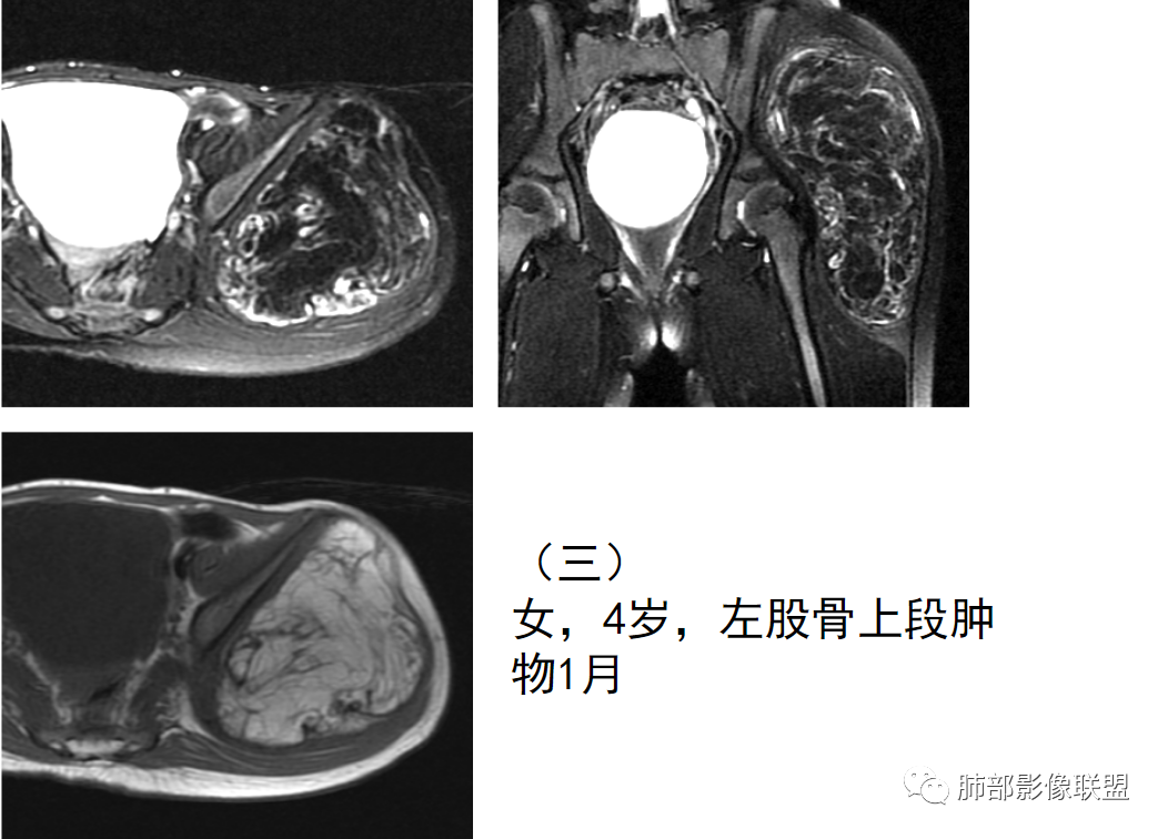 【病例】幼儿脂肪母细胞瘤1例CT影像-63