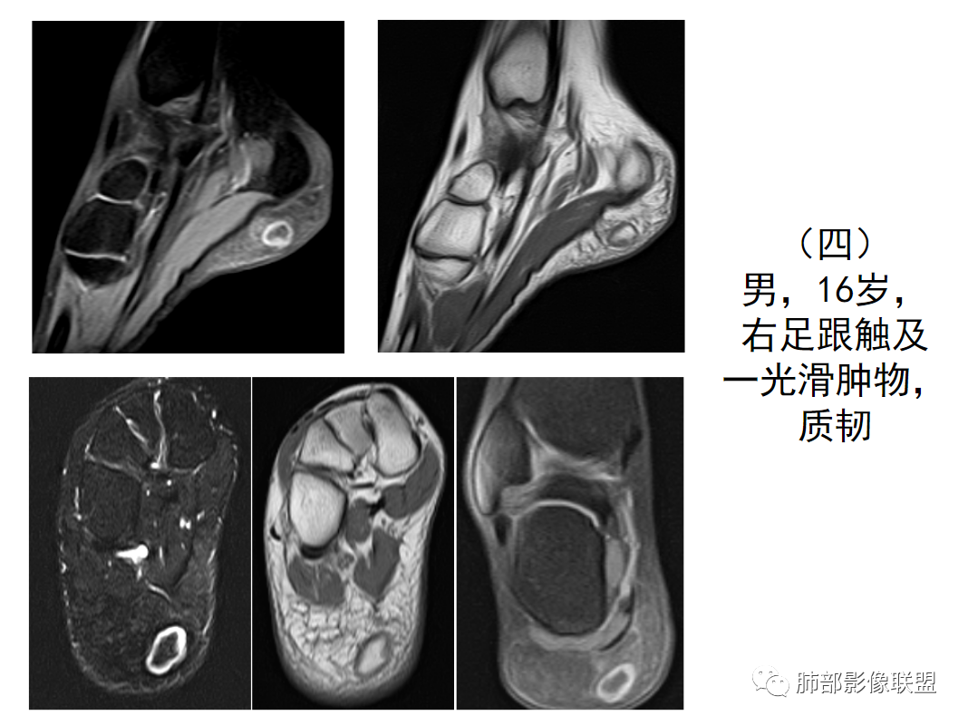 【病例】幼儿脂肪母细胞瘤1例CT影像-65