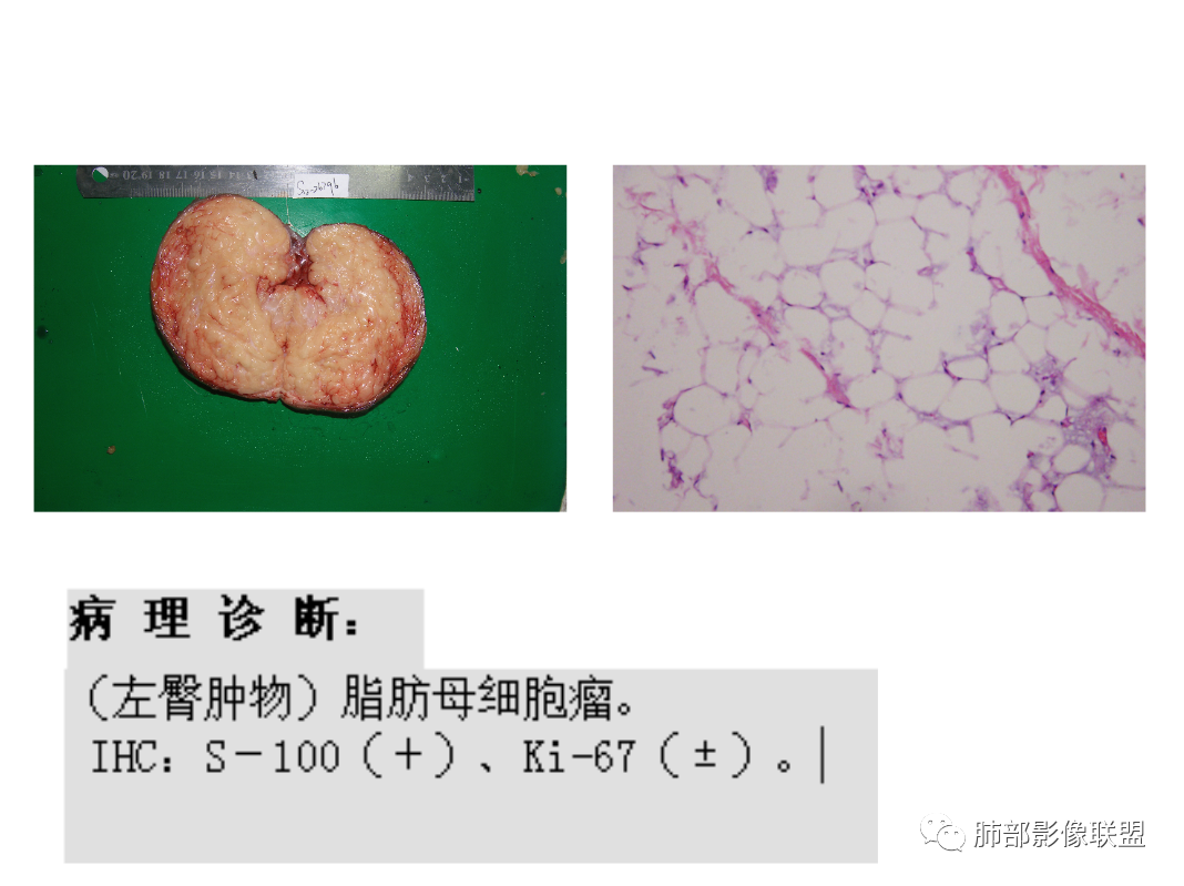 【病例】幼儿脂肪母细胞瘤1例CT影像-64