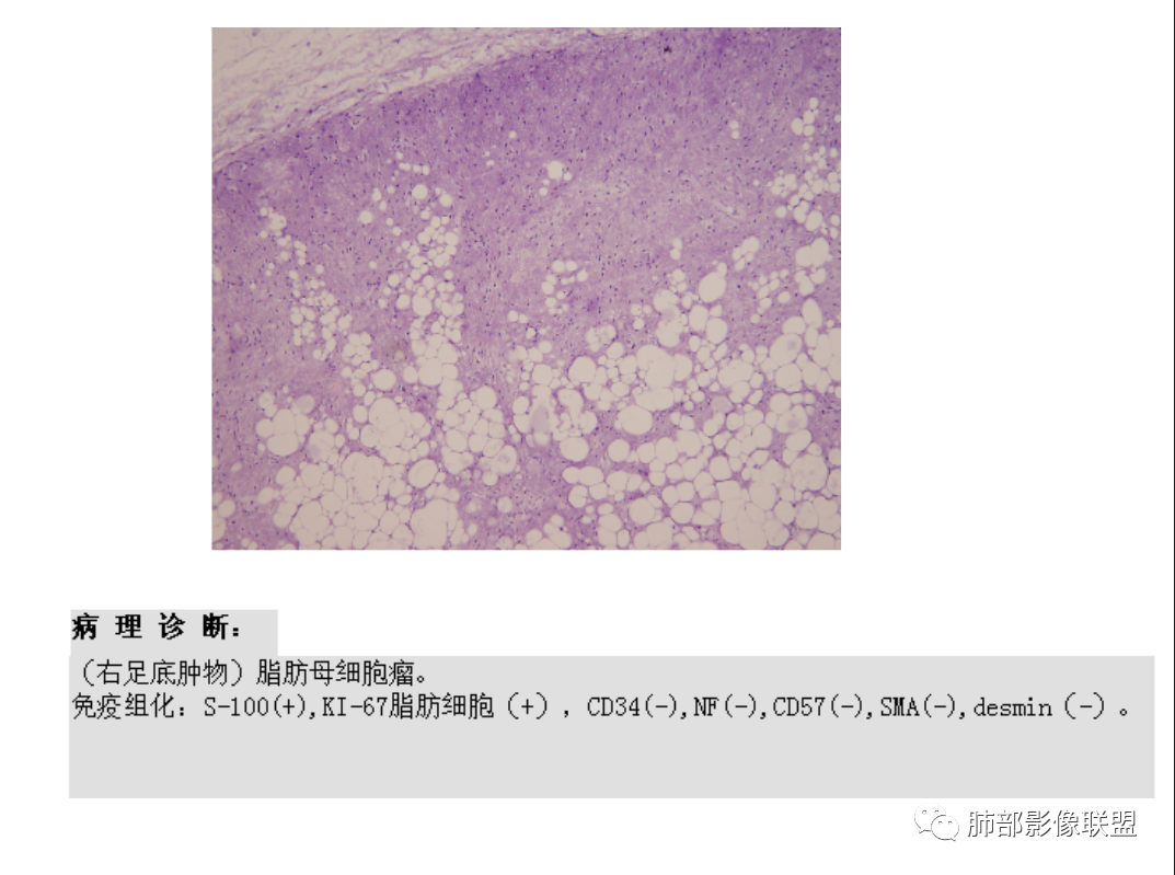 【病例】幼儿脂肪母细胞瘤1例CT影像-66