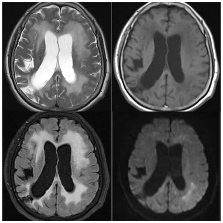 【病例】一氧化碳中毒性脑病1例MR影像-4