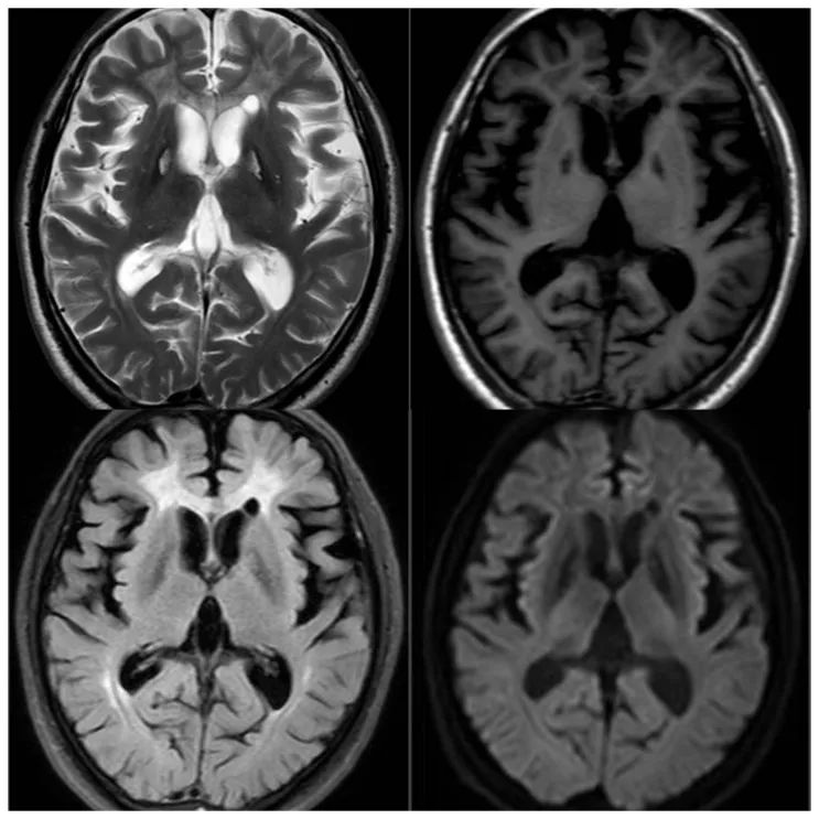 【病例】一氧化碳中毒性脑病1例MR影像-5