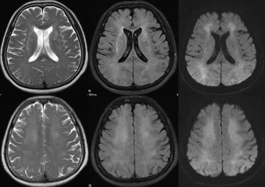 【病例】一氧化碳中毒性脑病1例MR影像-3