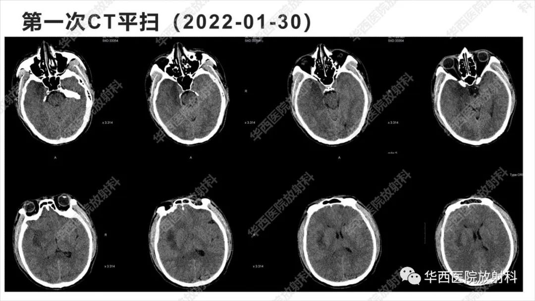 【病例】出血坏死性病毒脑膜脑炎1例CT及MR影像学表现和鉴别诊断-4