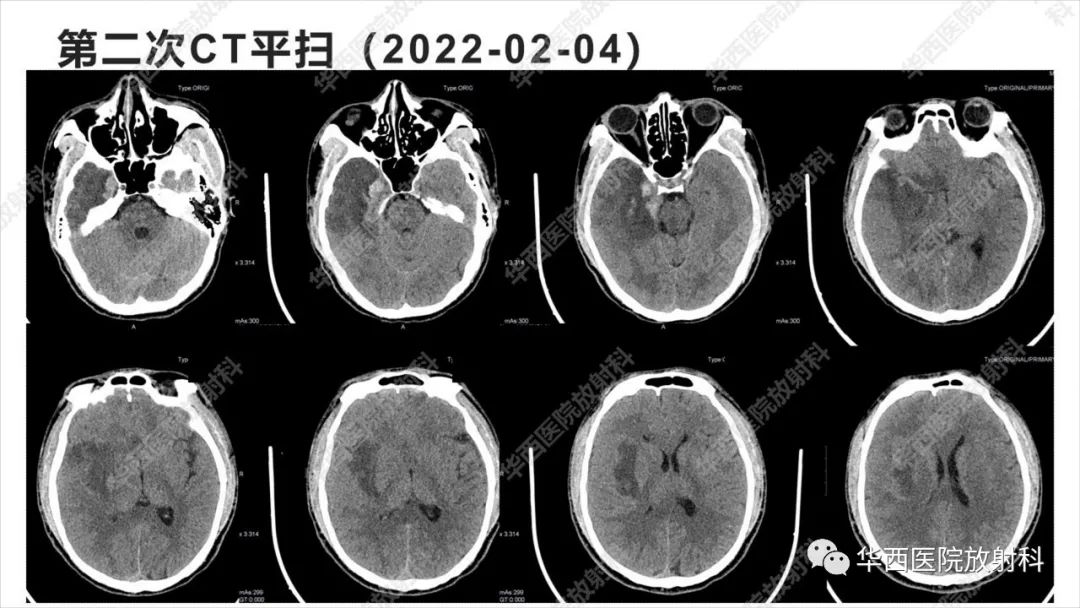 【病例】出血坏死性病毒脑膜脑炎1例CT及MR影像学表现和鉴别诊断-5