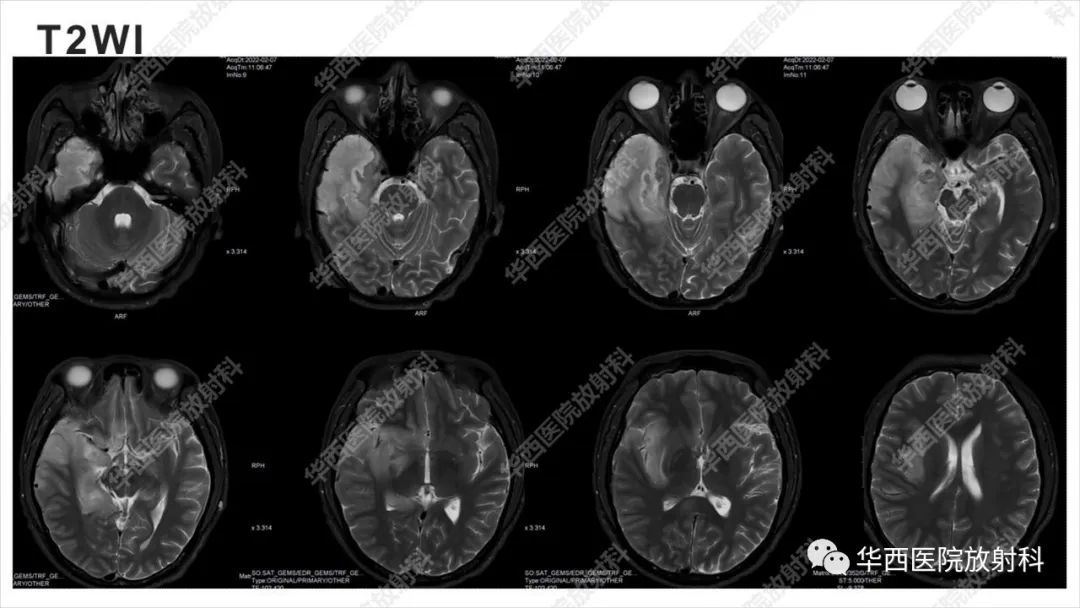 【病例】出血坏死性病毒脑膜脑炎1例CT及MR影像学表现和鉴别诊断-6