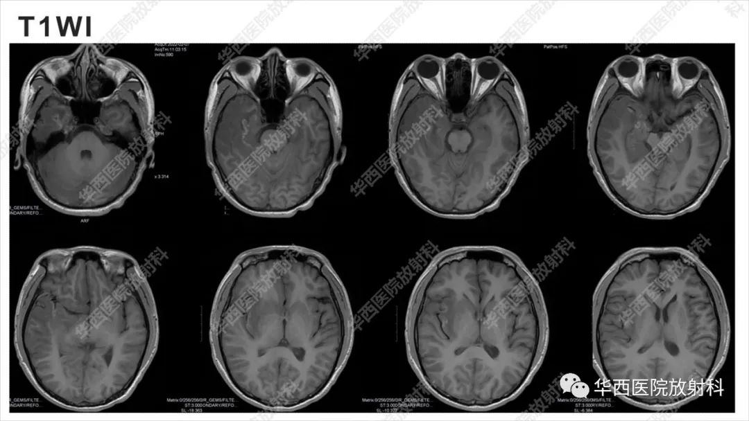 【病例】出血坏死性病毒脑膜脑炎1例CT及MR影像学表现和鉴别诊断-7