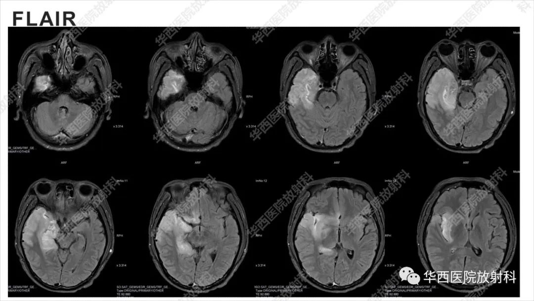 【病例】出血坏死性病毒脑膜脑炎1例CT及MR影像学表现和鉴别诊断-8