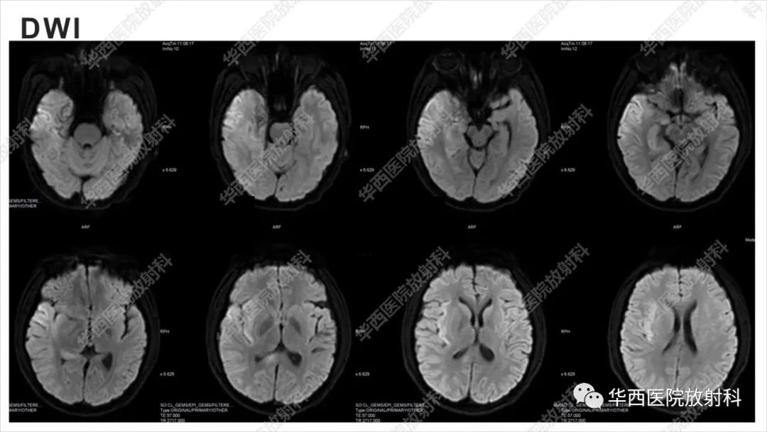 【病例】出血坏死性病毒脑膜脑炎1例CT及MR影像学表现和鉴别诊断-9