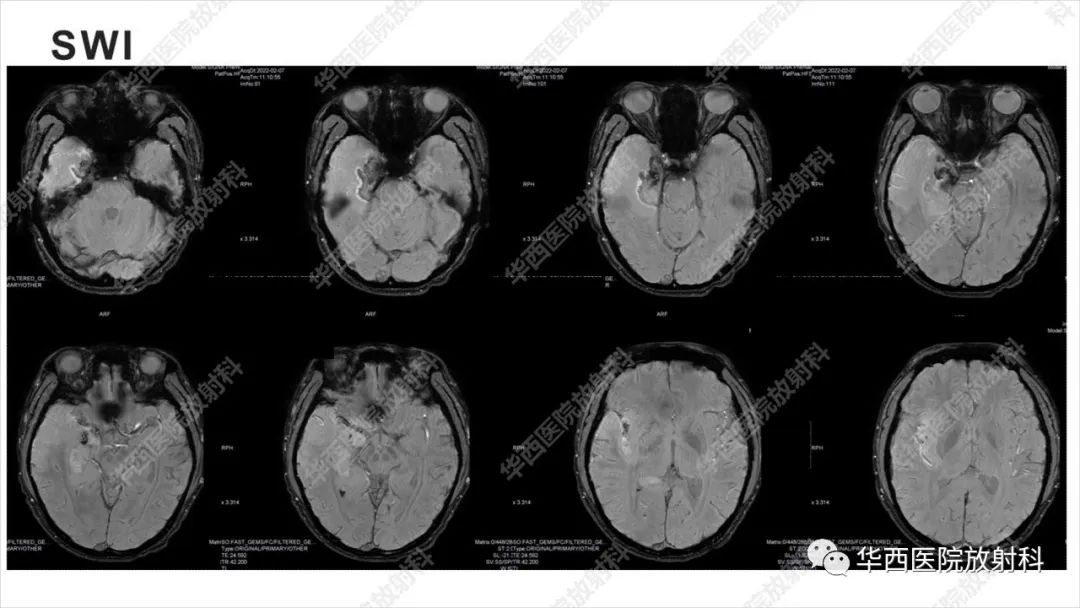 【病例】出血坏死性病毒脑膜脑炎1例CT及MR影像学表现和鉴别诊断-10