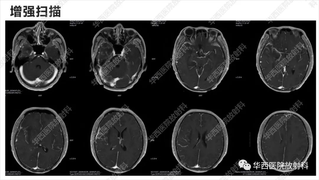 【病例】出血坏死性病毒脑膜脑炎1例CT及MR影像学表现和鉴别诊断-11