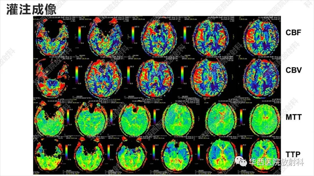 【病例】出血坏死性病毒脑膜脑炎1例CT及MR影像学表现和鉴别诊断-12