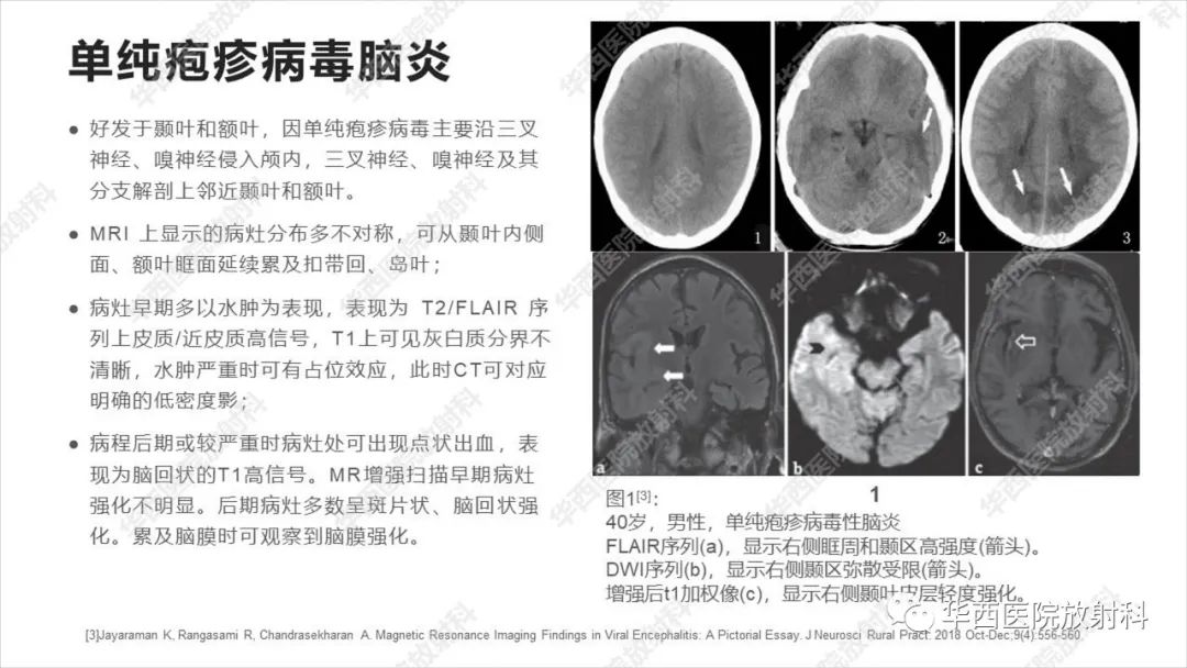 【病例】出血坏死性病毒脑膜脑炎1例CT及MR影像学表现和鉴别诊断-17