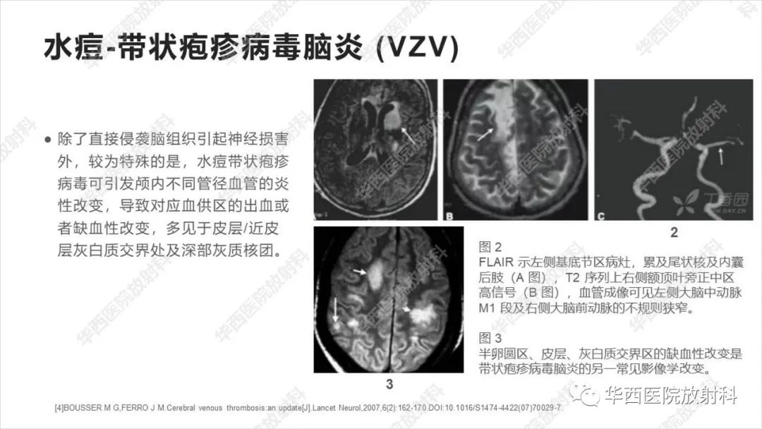 【病例】出血坏死性病毒脑膜脑炎1例CT及MR影像学表现和鉴别诊断-18