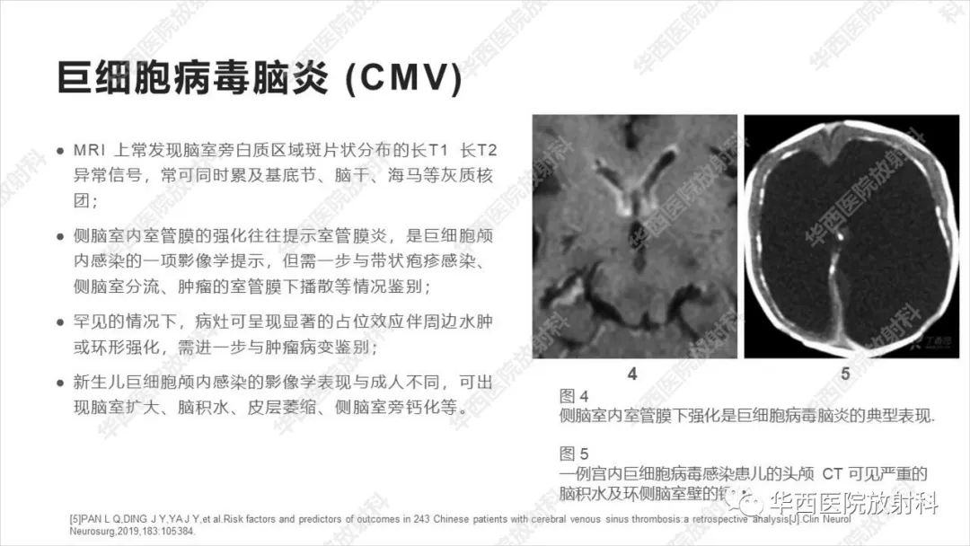 【病例】出血坏死性病毒脑膜脑炎1例CT及MR影像学表现和鉴别诊断-19
