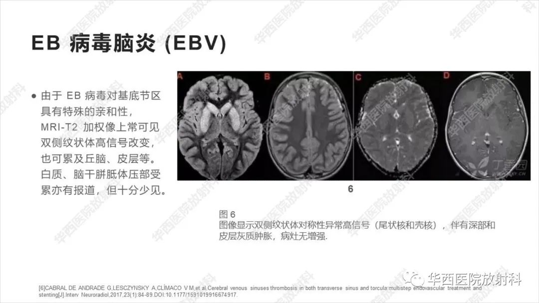 【病例】出血坏死性病毒脑膜脑炎1例CT及MR影像学表现和鉴别诊断-20