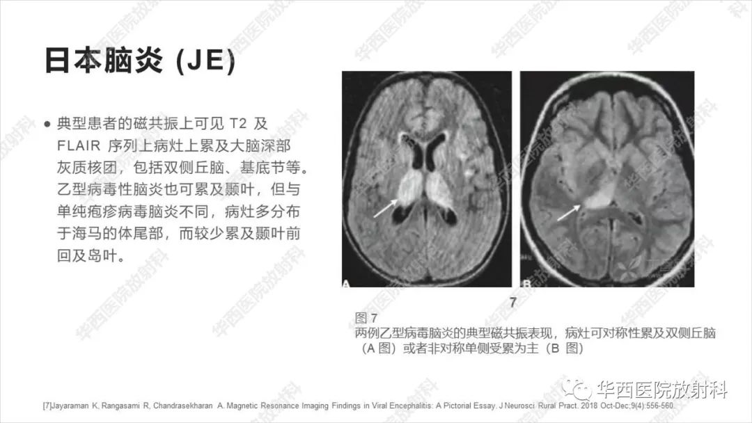 【病例】出血坏死性病毒脑膜脑炎1例CT及MR影像学表现和鉴别诊断-21