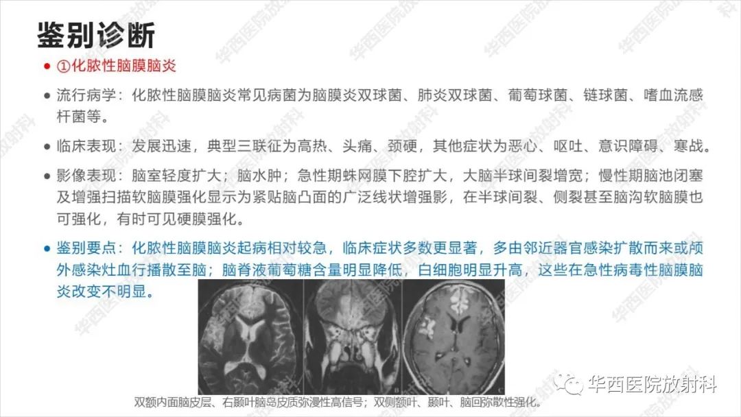 【病例】出血坏死性病毒脑膜脑炎1例CT及MR影像学表现和鉴别诊断-22